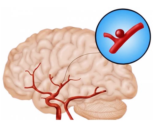 Аневризмы сосудов головного мозга